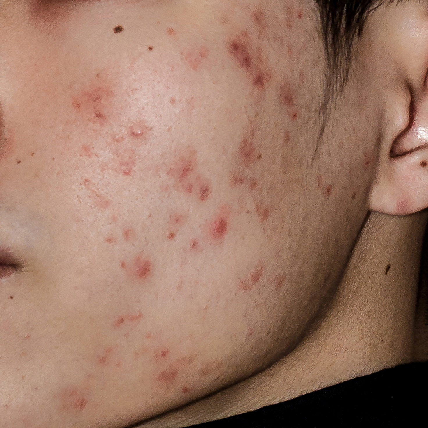 Acne or Pimples