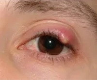Chalazion (Bump of Eyelashes)