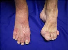 Charcot-Marie-Tooth Disease