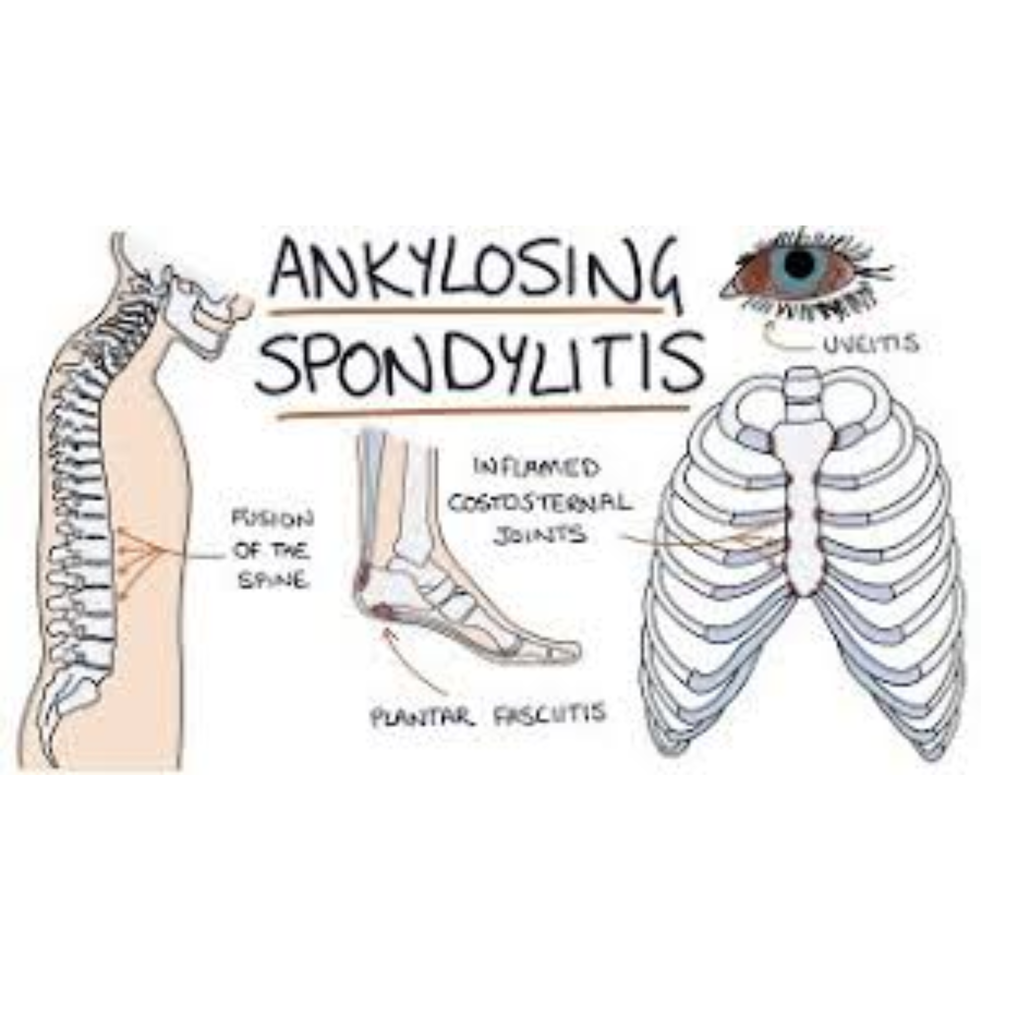 Ankylosing Spondylitis