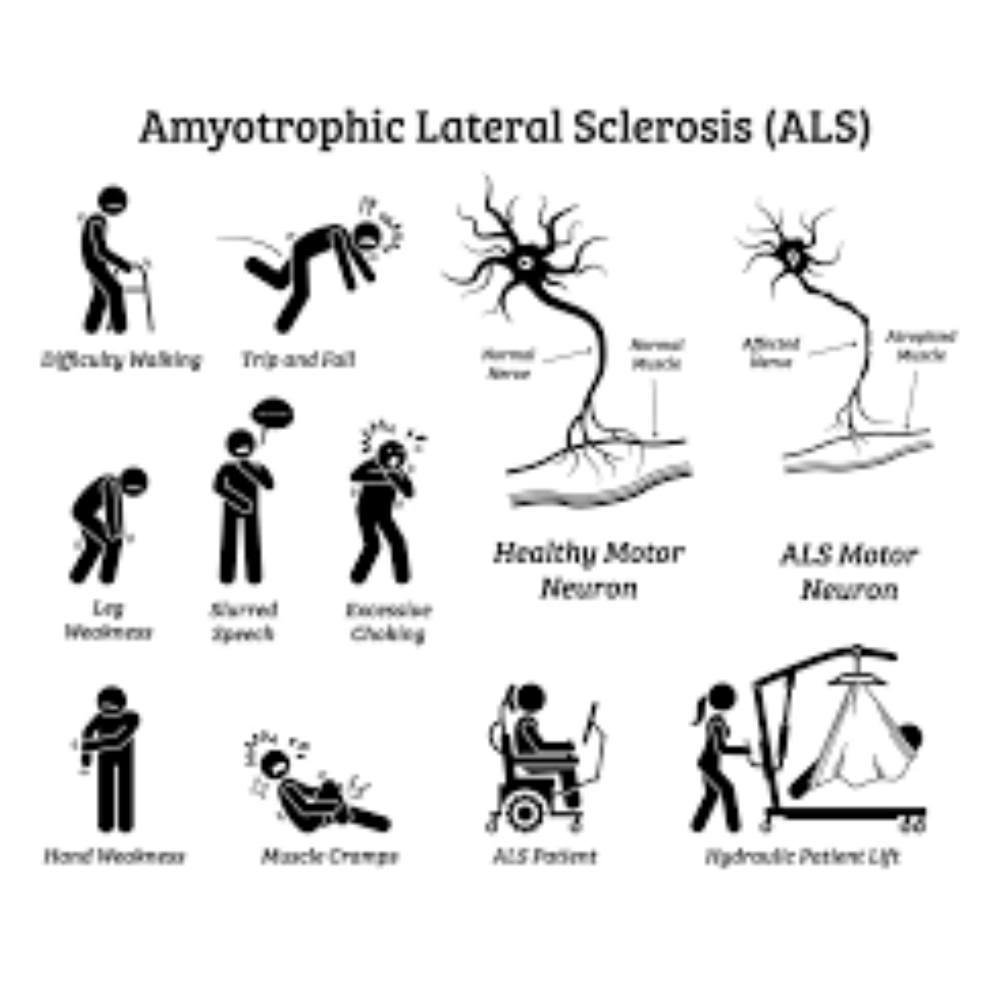 Amyotrophic Lateral Sclerosis (ALS) - Motor Neuron Weakness
