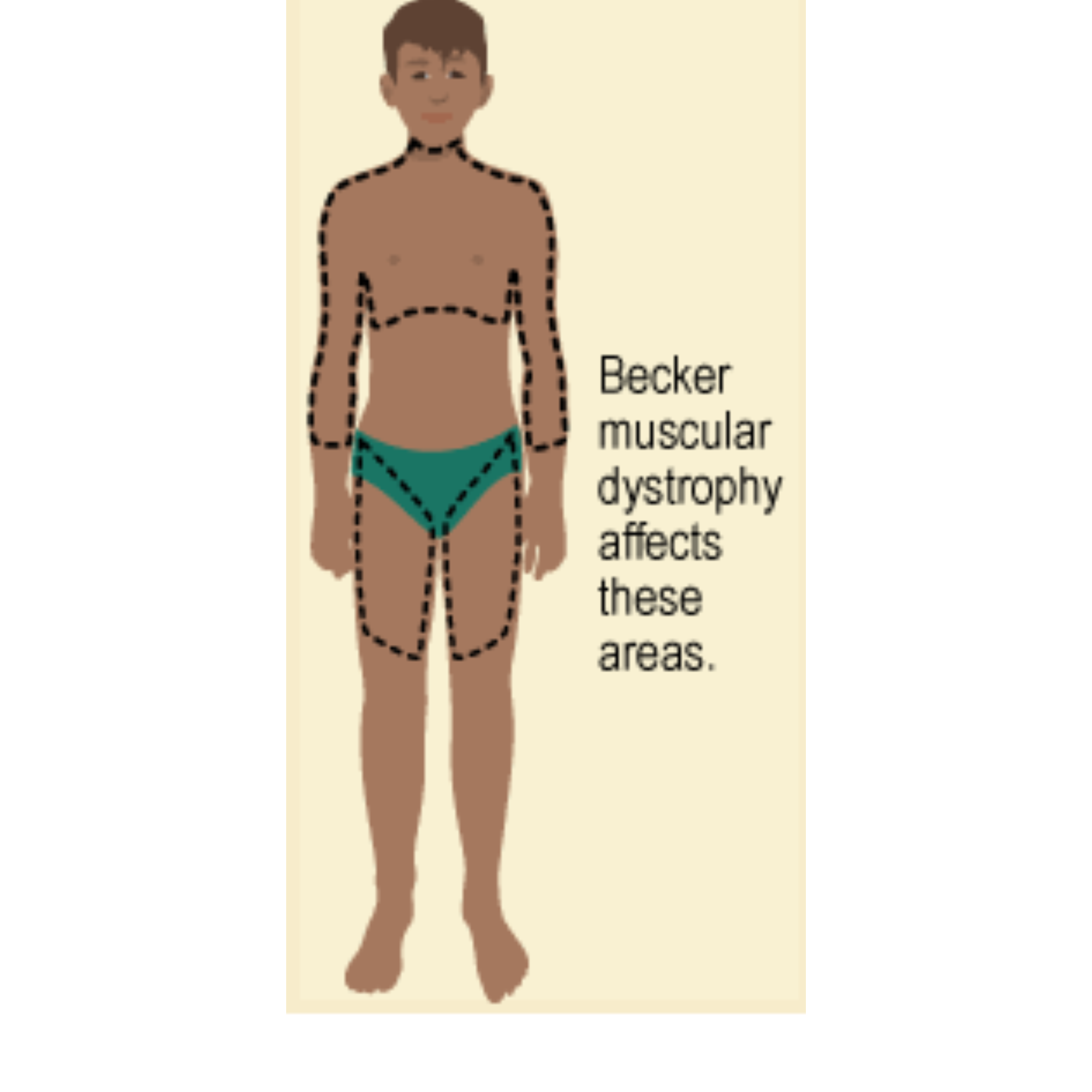 Becker Muscular Dystrophy (BMD)