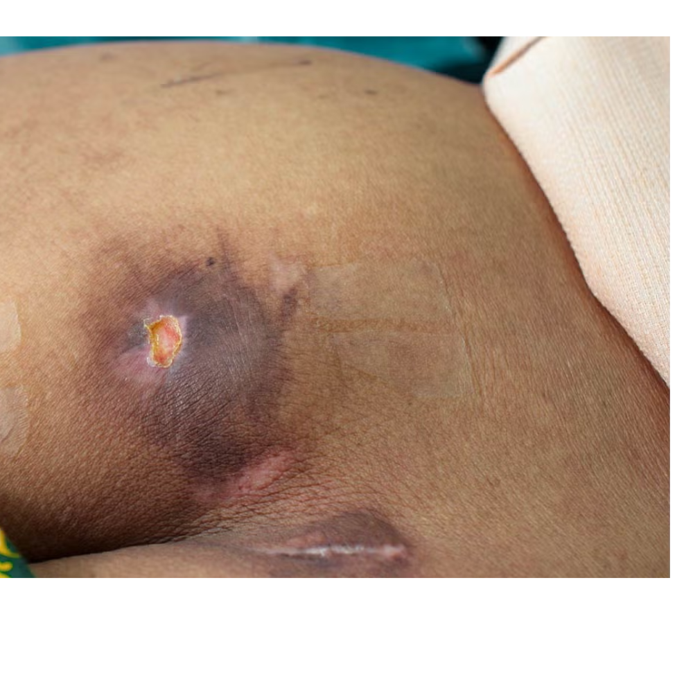 Bed Sores (Pressure Ulcers)