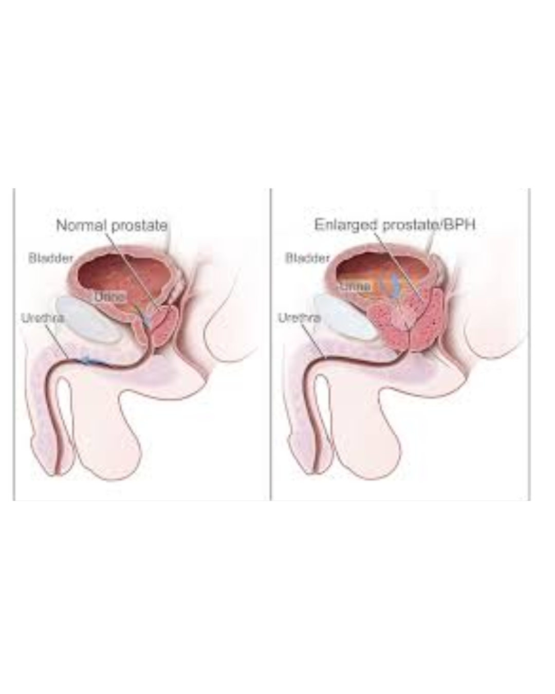 Benign Prostatic Hyperplasia
