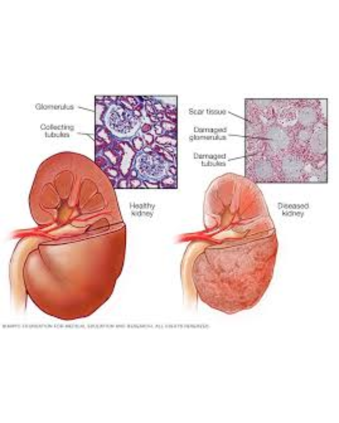 Chronic Kidney Disease