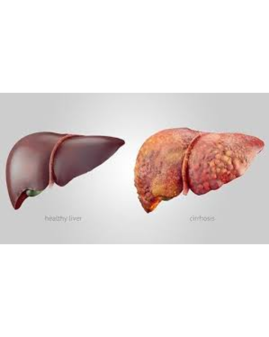 Chronic Liver Disease