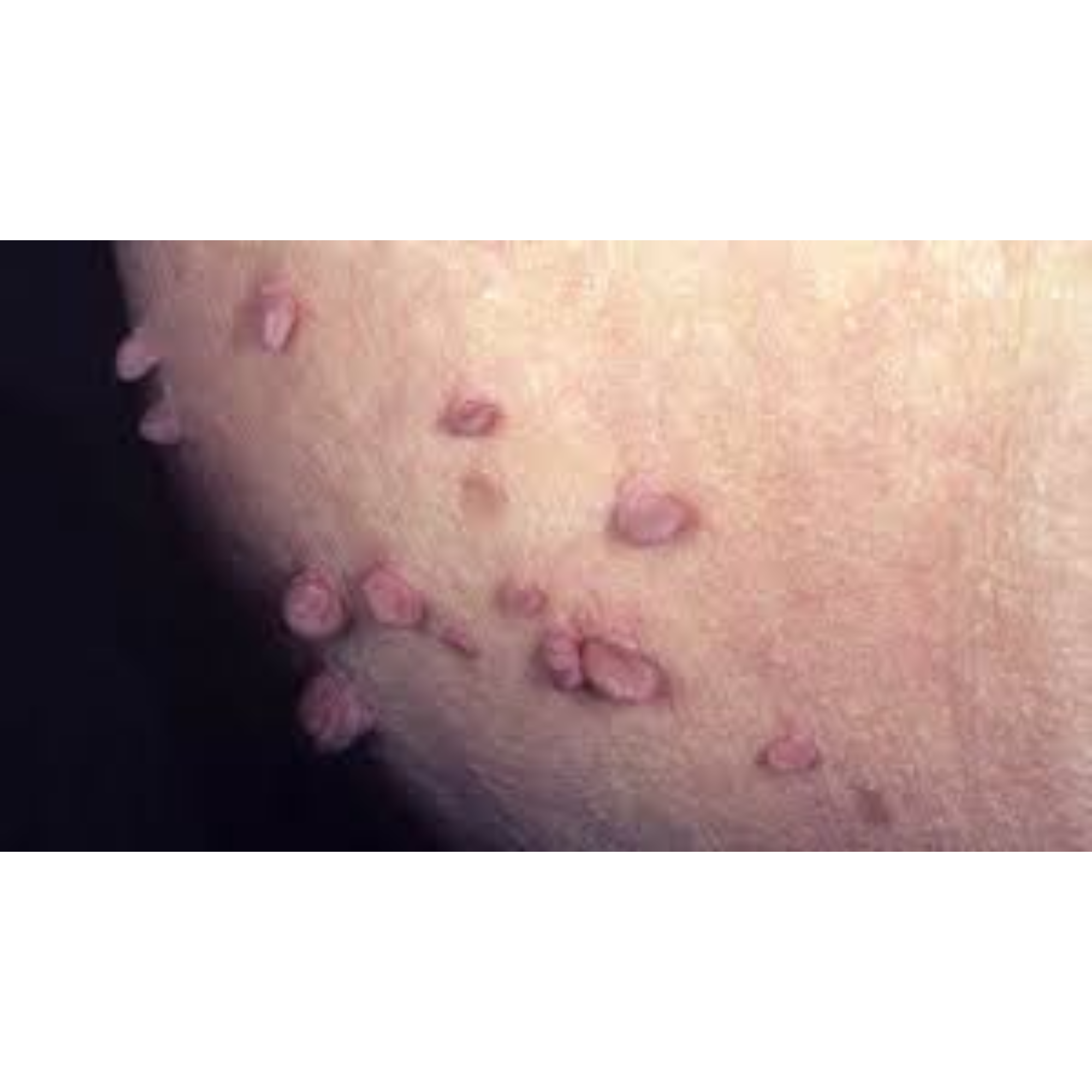 Acrochordon (Skin Tags or Massa)