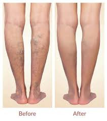 Varicose Veins