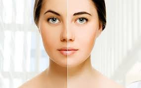 Skin Whitening