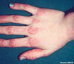 Dermatomyositis