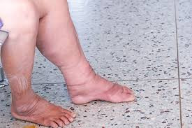 Elephantiasis/Filariasis