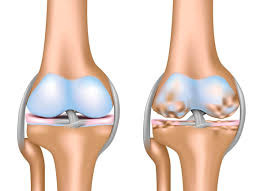 Osteoarthritis