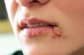 Herpes Simplex