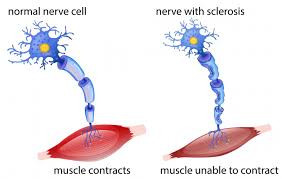Multiple Sclerosis