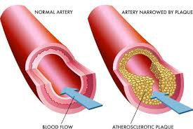 Atherosclerosis (High Cholesterol)
