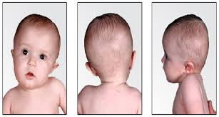 Torticollis