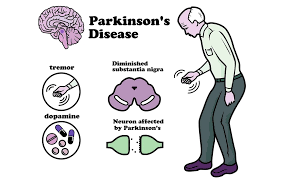 Parkinsonism