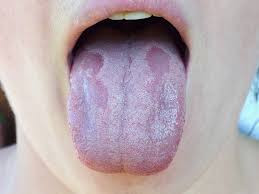 Oral Candidiasis (Oral Thrush)