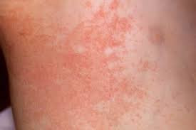 Heat Rash (Prickly Heat, Miliaria)
