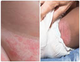 Diaper Dermatitis (Diaper Rash)