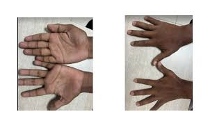 Hirayama Disease (HD)