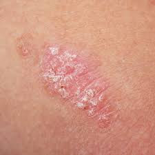 Psoriasis