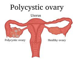 Polycystic Ovary Disease
