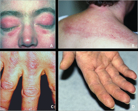 Inflammatory Myopathy