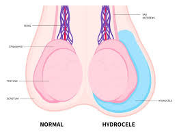 Hydrocele