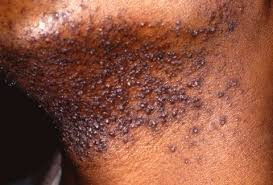 Pseudofolliculitis Barbae