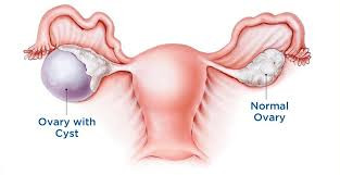 Ovarian Cyst