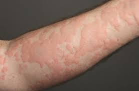 Urticaria (Hives)