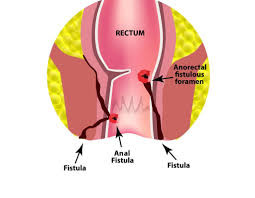 Anal Fistula