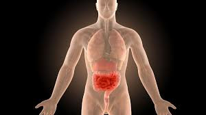 Crohn’s Disease/Colitis