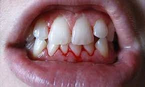 Pyorrhea (Periodontitis)