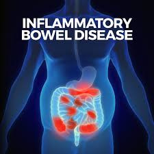 Inflammatory Bowel Disease