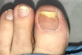 Fungal Nail Infection (Onychomycosis)