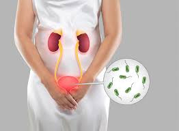 Urinary Tract Infection (UTI)
