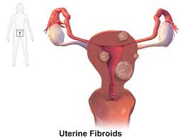 Fibroids (Uterine Myomas)