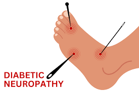 Diabetic Neuropathy