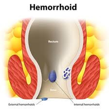 Haemorrhoids (Piles)