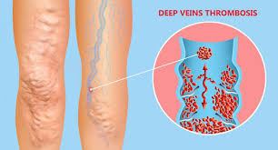 Deep Vein Thrombosis (DVT)