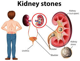Kidney Stones (Nephrolithiasis)