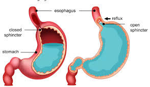 Gastroesophageal Reflux Disease