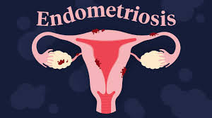 Endometriosis
