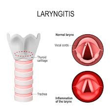 Laryngitis