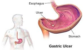 Gastric / Duodenal Ulcer
