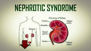 Nephrotic Syndrome