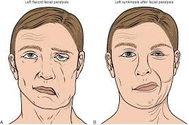 Progressive Bulbar Palsy