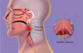 Pharyngitis